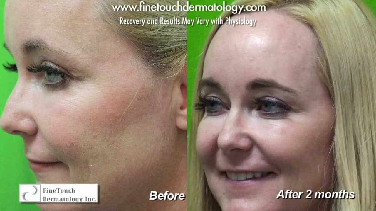 Crows feet removal before and after. Crows feet removal before and after.