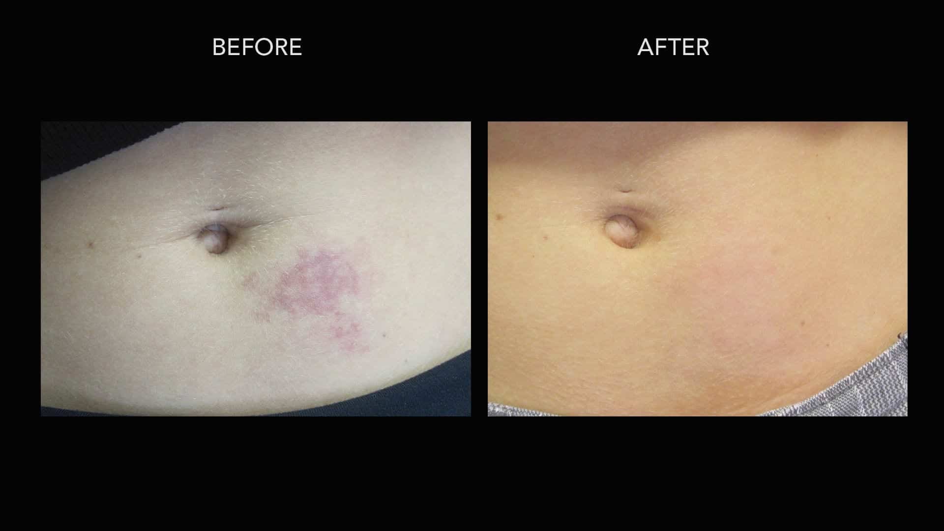 Turning to birthmark treatment, this patient was able to greatly reduce the appearance of her stomach birthmark.