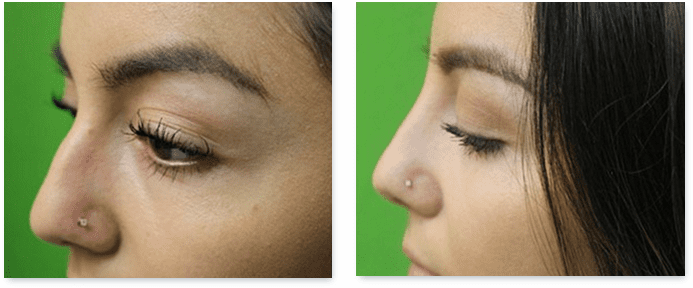 Non surgical nose job before and after