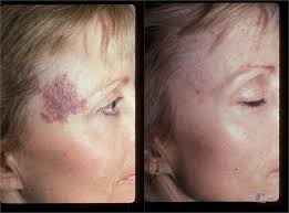 Turning to birthmark removal, this patient was able to greatly reduce the appearance of her facial birthmark.