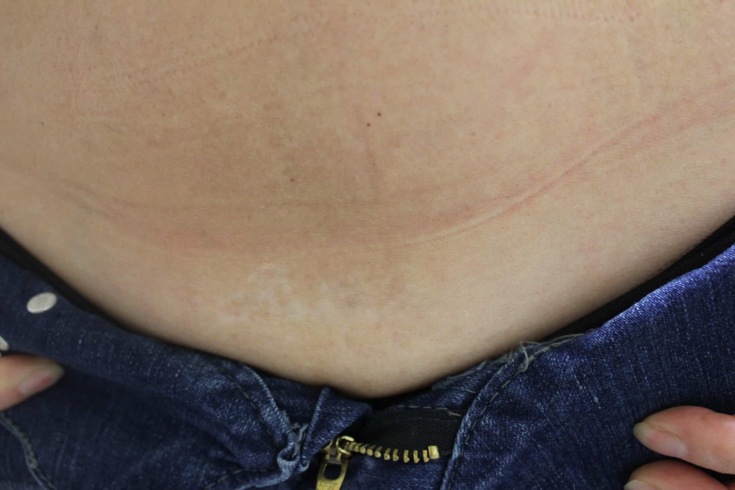 This patient is thrilled with the results, her regretful tattoo is no longer an eye sore.*