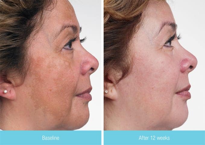 If you're wondering how to stop melasma, there are may preventative forms, however, laser therapy is the most effective one it has already appeared on the skin.
