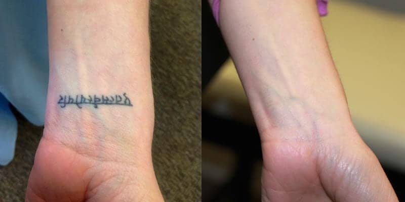 Tattoo removal by laser: laser tattoo removal before and after