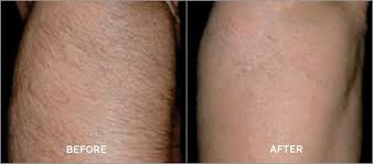 Before and after photo of a patient who received laser hair removal for his upper arm.* Before and after photo of a patient who received laser hair removal for his upper arm.