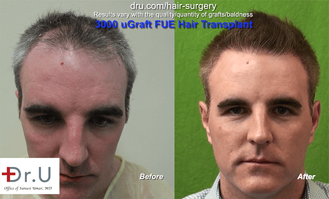 How to address thinning hair: Dr.UGraft FUE Transplant to help thinning hair