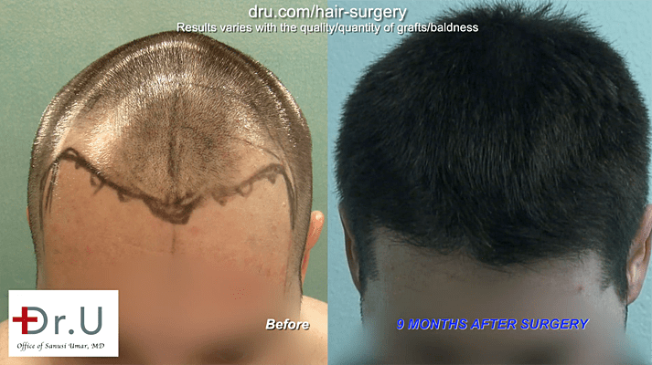 Photo shows area of onset of Hair Loss After Hair Transplant. Photo shows area of onset of Hair Loss After Hair Transplant.