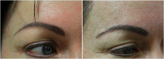 Eyebrow graft with the DrUGraft method