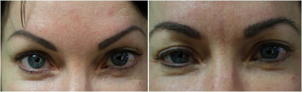 Before and after eyebrow hair transplant with Dr. Umar