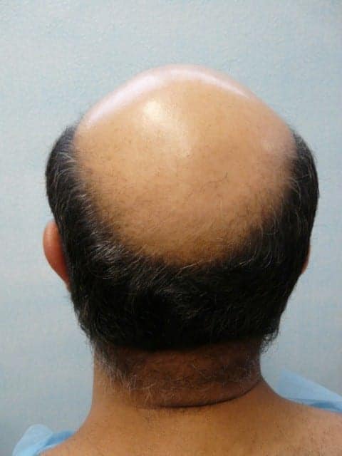 Heredity causes most hair loss in men. Doctors hope to one day develop a hair loss cure.