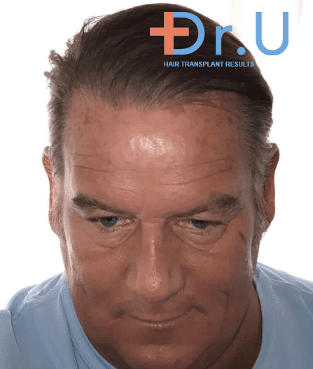 After treatment by Dr. Umar, this patient showed no signs of hair loss