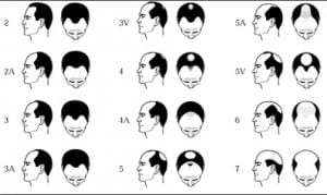 Norwood Scale* Norwood Scale*