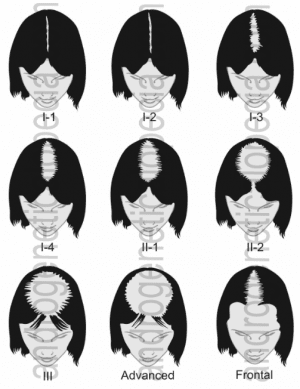 Hair loss in women: the Savin Scale 