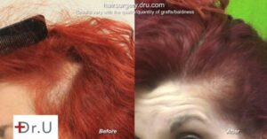 Female hair restoration before and after: Traction alopecia can be treated with hair transplant for women.