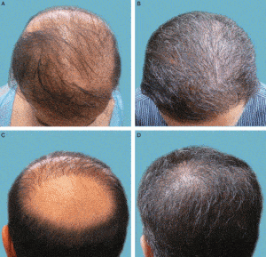 New Body Hair Transplant Study Show Severe Baldness Reversed: Patient Outcomes Positive* New Body Hair Transplant Study Show Severe Baldness Reversed: Patient Outcomes Positive*