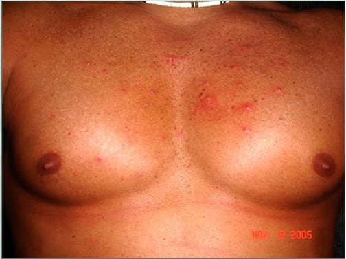 Red bumps can occur as a normal part of FUE hair transplant recovery
