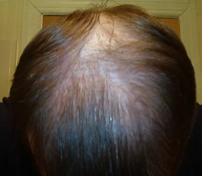 The DrUGraft procedure offers better hair loss solutions than hair loss concealers The DrUGraft procedure offers better hair loss solutions than hair loss concealers