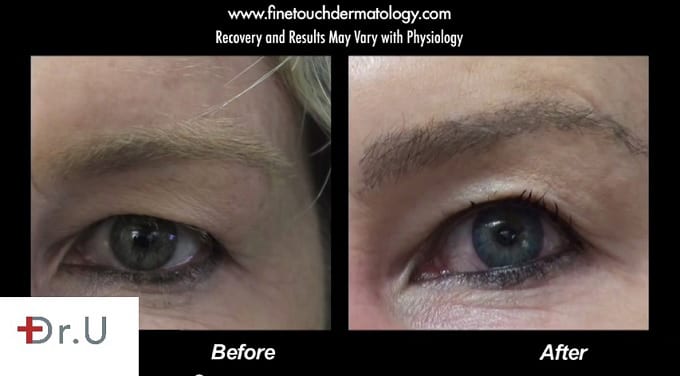 "Brooke Shields" density eyebrow restoration thanks to Dr.UGraft.