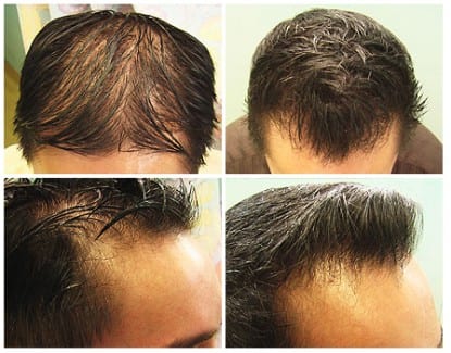 Results of Dr.UGraft Asian FUE hair transplant Results of Dr.UGraft Asian FUE hair transplant