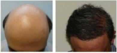 Until Cloning hair follicles becomes a reality, DrUGraft methods of head and body transplants offers a way to treat severe hair loss Until Cloning hair follicles becomes a reality, Dr.UGraft methods of head and body transplants offers a way to treat severe hair loss