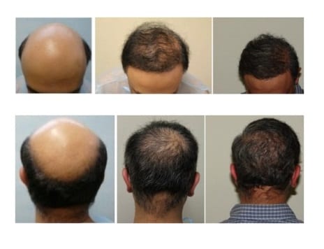 Hair follicle cloning or hair cell cloning trials have yet to become scientific reality Hair follicle cloning or hair cell cloning trials have yet to become scientific reality