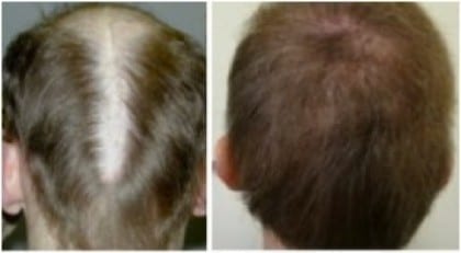 Crown hair transplant repair by Dr. Umar