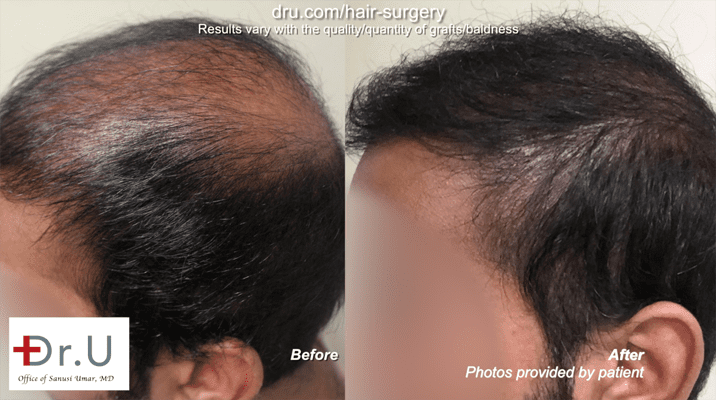Before and after Hair transplant repair using beard and chest hair