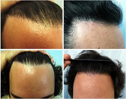 Transplant body hair to head: Elimination of pluggy look with the DrUGraft method