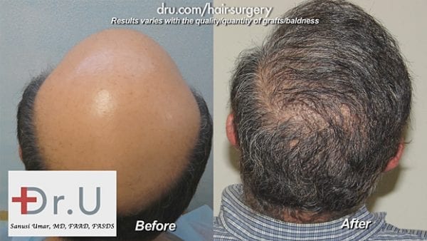 Included in the BHT study published by the Aesthetic surgery Journal is this NW 7 severely bald patient who was restored to normalcy using UGraft BHT* Included in the BHT study published by the Aesthetic surgery Journal is this NW 7 severely bald patient who was restored to normalcy using UGraft BHT*