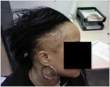 Extensive hair loss on the edges and hairline in an African American woman