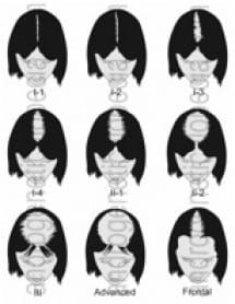 Contrary to popular belief, women do experience hair loss. Female hair transplant offers treatment