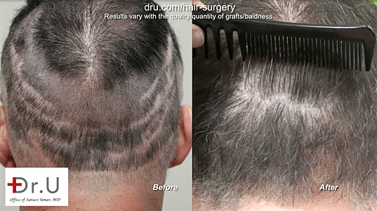 This Dr. U patient can no longer see the intense scarring he had from his previous FUSS surgeries.*