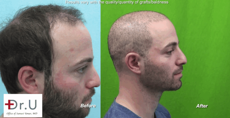 Is there a minimum age for a hair transplant? Dr U says No. This young age hair transplant patient found his solution from Dr.UGraft BHT Hair surgery which fixed his scar and baldness allowing for a buzz cut*