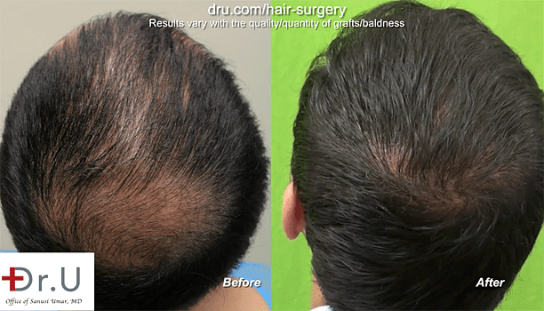 Full Hair Restoration with Body Hair: Body hair transplant success