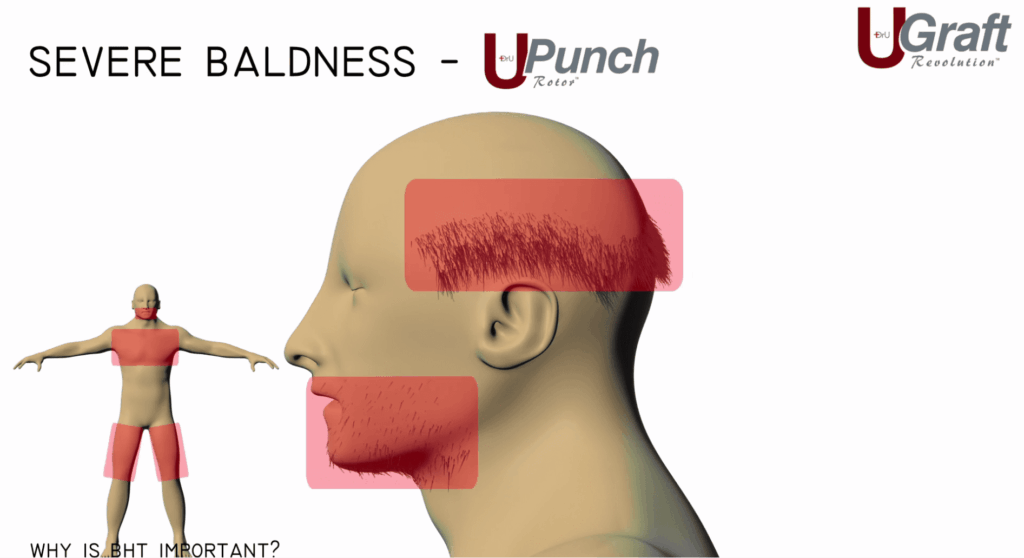 Dr.UGraft is able to pull hair from the beard and head to create fuller coverage on the top of the head.*