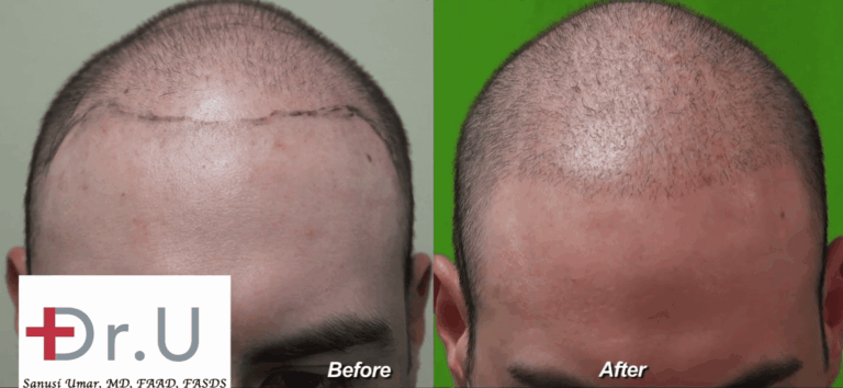 Los Angeles Young Adult Hair Transplant Using Dr.UGraft: Before and After a Less Is More Approach for a Low Budget Hair Transplant*