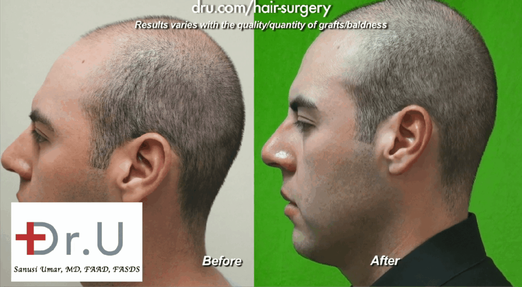 Best Age for a hair transplant: Dr.UGraft Method used by Dr. U eliminates the need for defining a hair transplant age limit as discovered by this young adult Los Angeles patient*