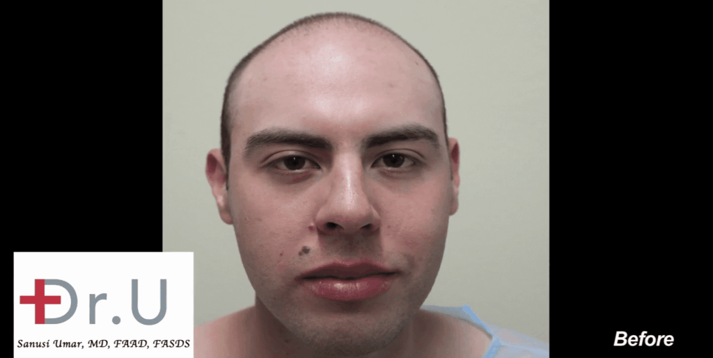 This patient began balding at a very young age. He came to Dr. Umar to help maintain his youthful appearance.*