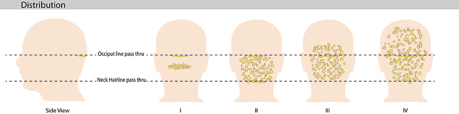 As AKN progresses, it can cover different areas and leave bumps on the back of the head and neck, and bumps on scalp.* As AKN progresses, it can cover different areas and leave bumps on the back of the head and neck, and bumps on scalp.*