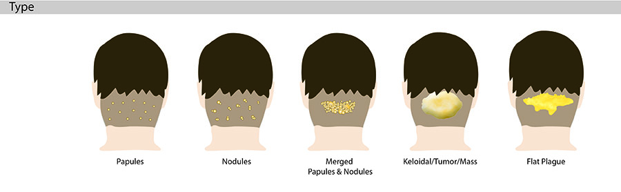 The bumps on the back of the head and neck that appear with acne keloidalis nuchae AKN can take one of these four shapes or forms.* The bumps on the back of the head and neck that appear with acne keloidalis nuchae AKN can take one of these four shapes or forms.*