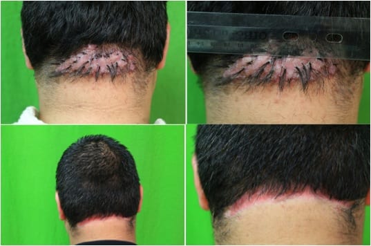 Even with a big bump on back of head, surgical removal changed this patient’s life.*
