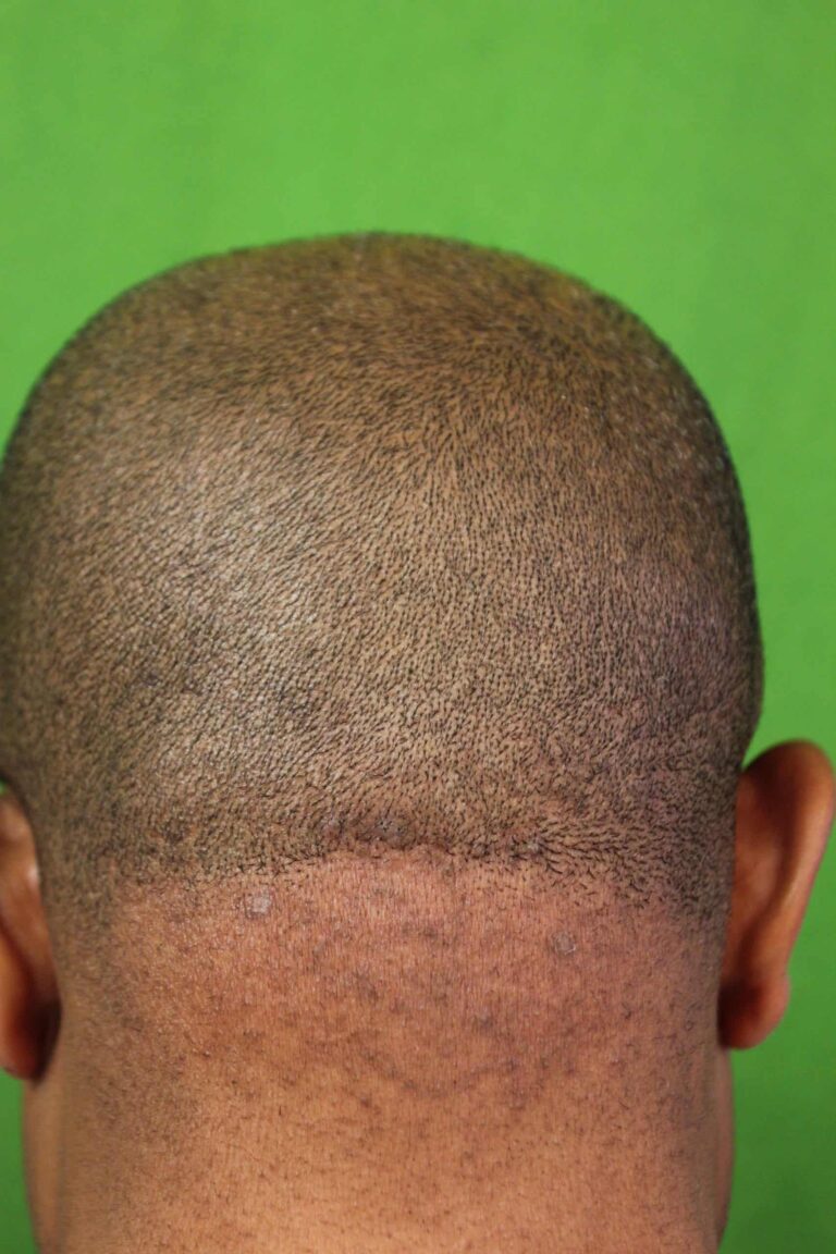 With Dr. U and ND:YAG lasers, there is a cure for the persistent bump on the back of your head and neck.* With Dr. U and ND:YAG lasers, there is a cure for the persistent bump on the back of your head and neck.*
