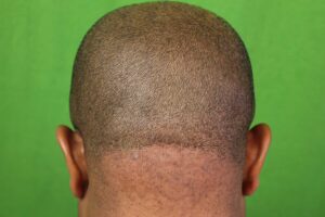 Post painful bump on back of head laser treatment with Dr U