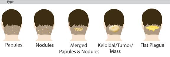 Acne Keloidalis Nuchae bumps can manifest and progress in different forms. Dr. U approaches each case in an individual manner to get rid of the bumps or keloid-like mass on the back of the head. The chart above shows the manner in which this condition can progress. 