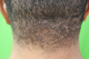 Pre-treatment with painful bumps on back of head laser cure