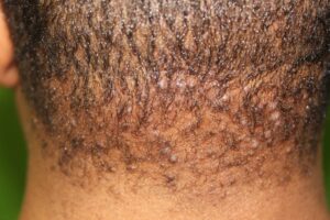 Patient before undergoing bumps on back of head laser treatment for AKN or acne keloidalis nuchae laser treatment
