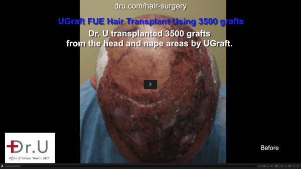 Hair transplant confidence: The patient hoped for increased confidence after hair transplant with a restored hairline.