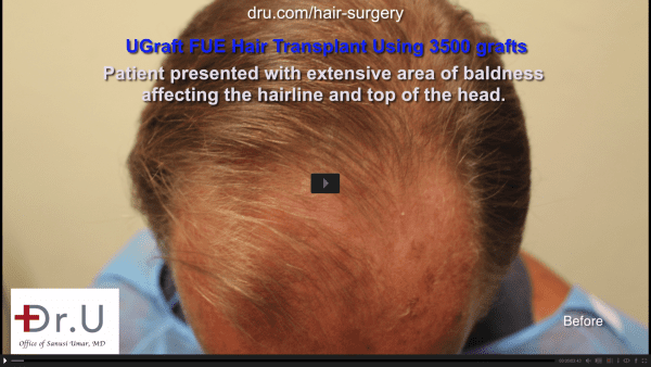 Hair transplant temple area: The patient wanted a conservative hairline and coverage that looks full but he wants the result to be not immediately obvious
