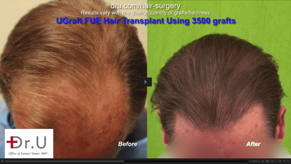 Natural hair transplant results Before and After: the patient has a fuller, natural looking hairline and temple area.