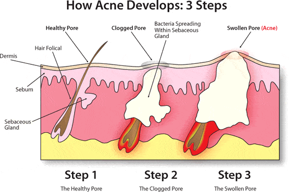 Acne treatment can easily remove a zit like this.