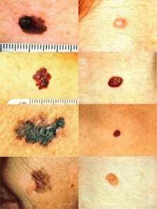 A variety of moles 